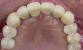 Tooth Replacement Bangalore