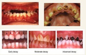 kids Dentistry In Bangalore