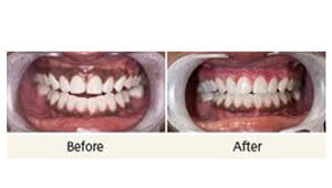 chisel dental clinic bangalore